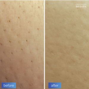 LHR_Before_After_360x360